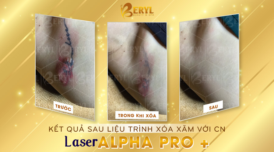 Hình ảnh trước và sau khi xóa hình xăm màu bằng Laser Alpha Pro+ tại Beryl Beauty. 