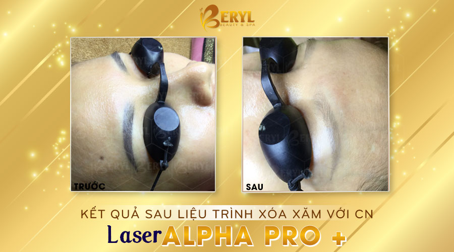 Hình ảnh trước và sau khi xóa xăm chân mày bằng Laser Alpha Pro+ tại Beryl Beauty.