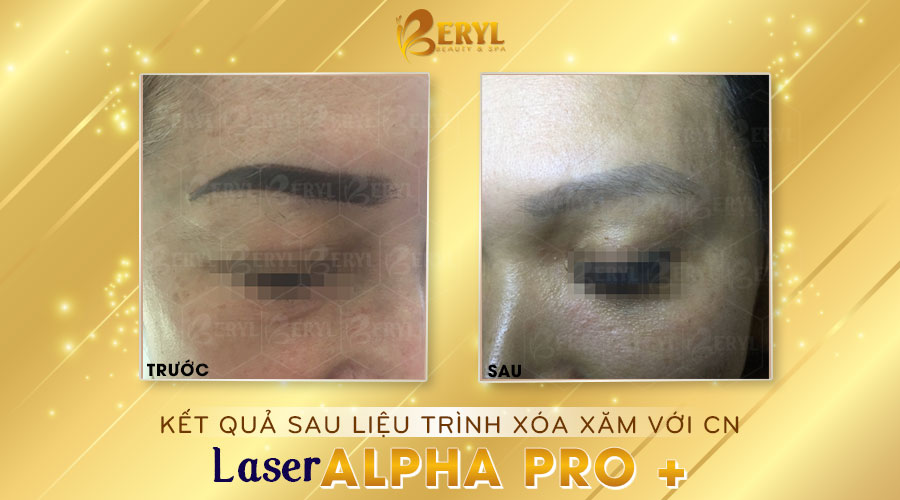 Hình ảnh trước và sau khi xóa xăm chân mày bằng Laser Alpha Pro+ tại Beryl Beauty.