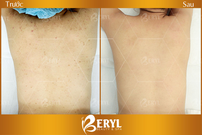 Hình ảnh trước và sau khi điều trị thâm mụn ở lưng bằng công nghệ Tảo Silic Tại Beryl Beauty & Spa