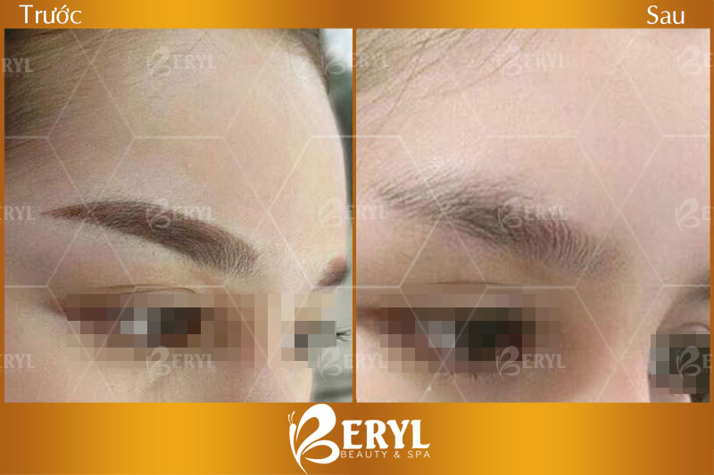 Hình ảnh trước và sau khi xóa lông mày hiệu quả tại Beryl Beauty & Spa TPHCM