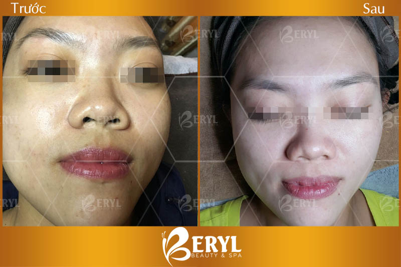 Hình ảnh trước và sau làm trắng da mặt bằng công nghệ Magic Skin tại Beryl Beauty