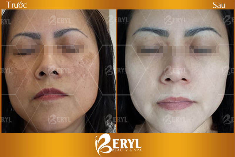 Hình ảnh trước và sau điều trị nám bằng CN Magic Skin tại Beryl Beauty