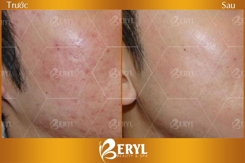 Hình ảnh trước và sau khi lăn kim trị sẹo trên mặt tại Beryl Beauty & Spa
