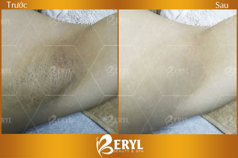 Hình ảnh điều trị thâm nách bằng công nghệ Peeling tại Beryl Beauty 
