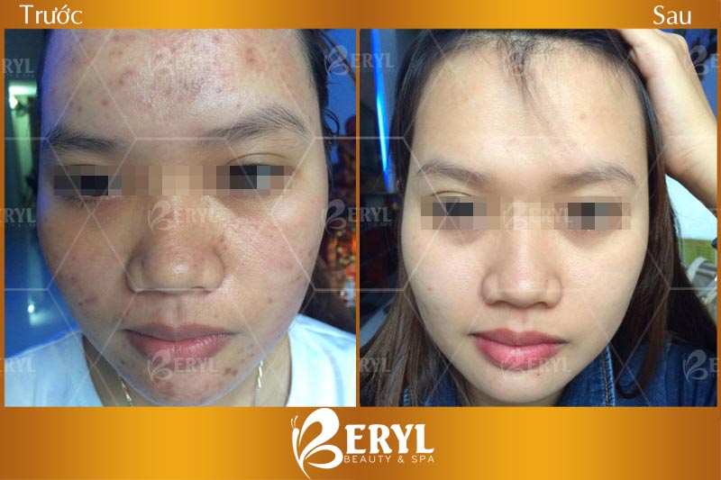 Hình ảnh trước và sau khi điều trị thâm mụn bằng công nghệ Magic Skin tại Beryl Beauty