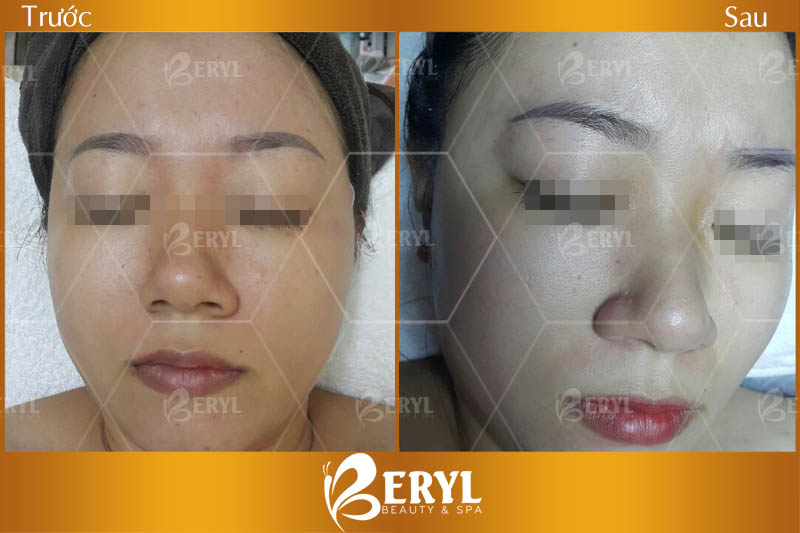 Hình ảnh trước và sau khi làm trắng da mặt bằng công nghệ độc quyền Baby Skin