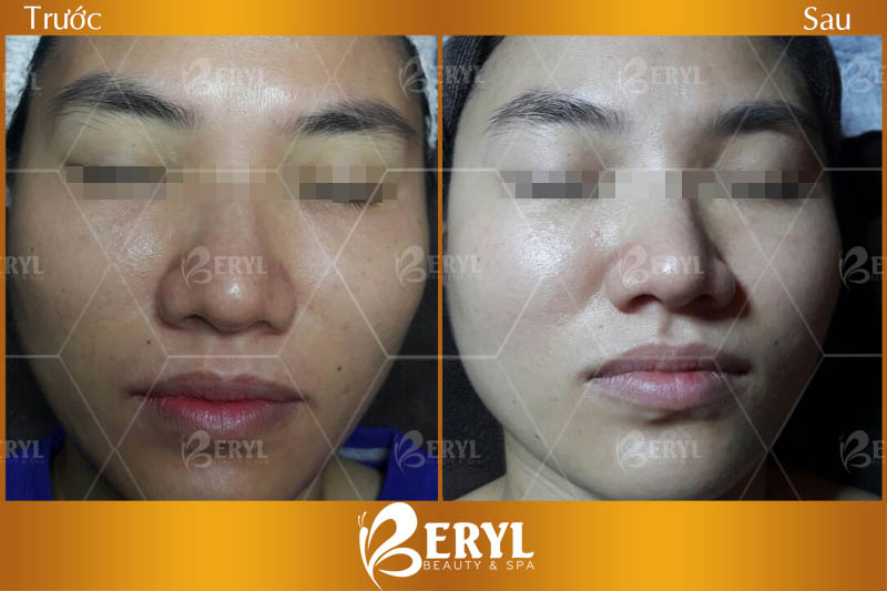 Hình ảnh trước và sau làm trắng da mặt bằng công nghệ Baby Skin tại Beryl Beauty
