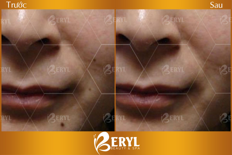 Hình ảnh trước và sau xóa nốt ruồi bằng Laser tại Beryl Beauty & Spa
