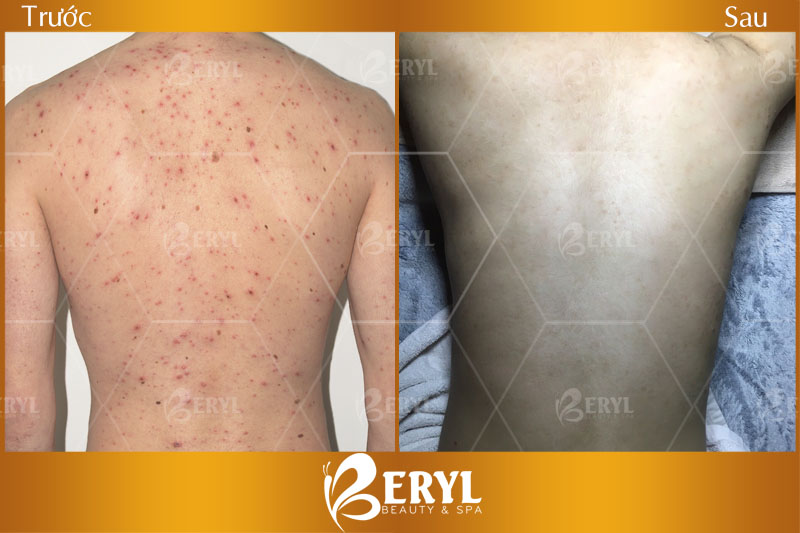 Hình ảnh trước và sau khi điều trị mụn ở lưng cho nam giới tại Beryl Beauty & Spa