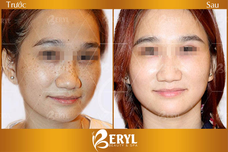 Hình ảnh trước và sau khi trị tàn nhang tại Beryl Beauty