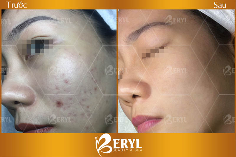 Hình ảnh trước và sau khi điều trị thâm mụn bằng công nghệ Magic Skin tại Beryl Beauty