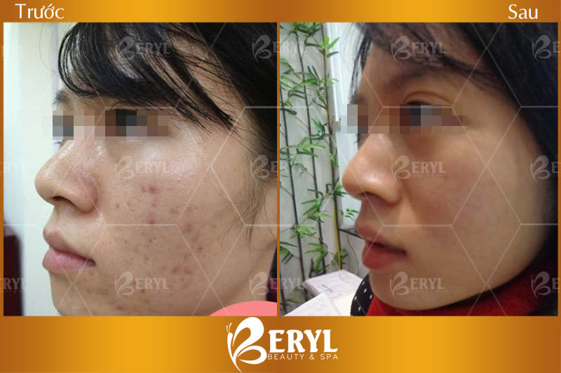 Hình ảnh điều trị thâm do mụn bằng công nghệ Magic Skin tại Beryl Beauty
