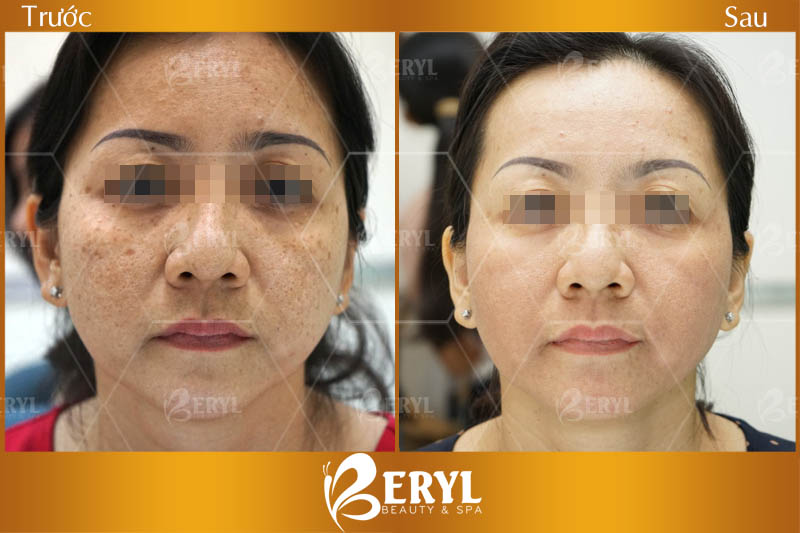 Hình ảnh trước và sau khi trị nám bằng công nghệ Magic Skin tại Beryl Beauty