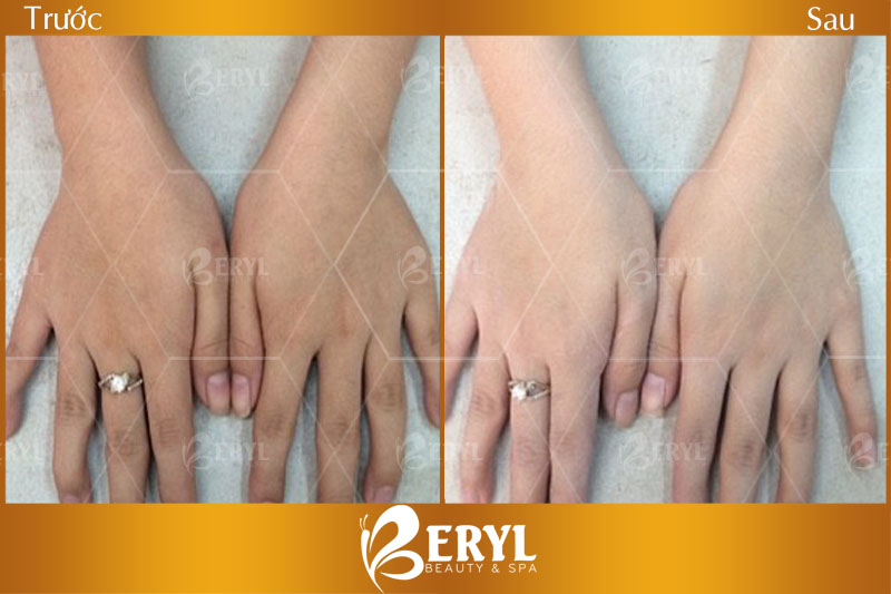 Hình ảnh trước và sau khi thay da sinh học và chăm sóc tại Beryl Beauty & Spa