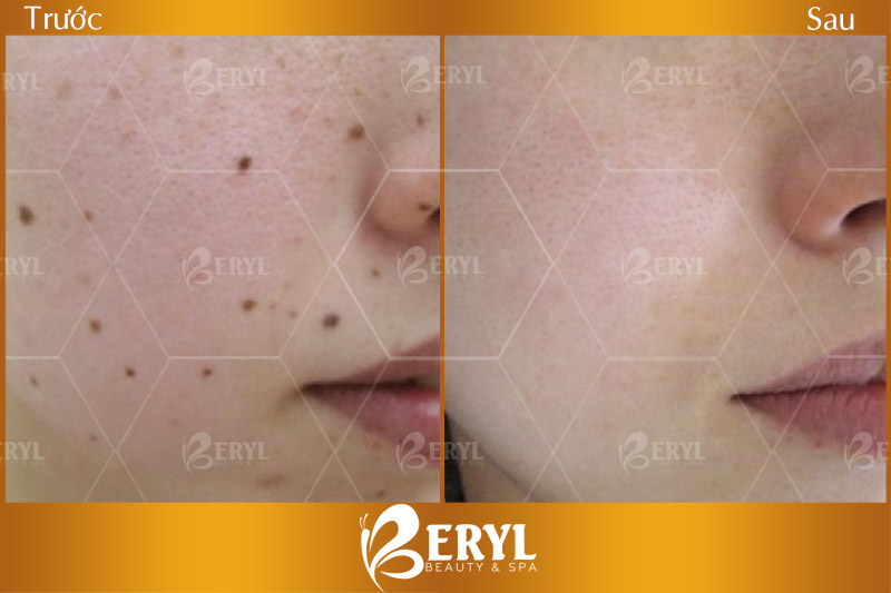 Hình ảnh trước và sau xóa nốt ruồi bằng Laser tại Beryl Beauty & Spa