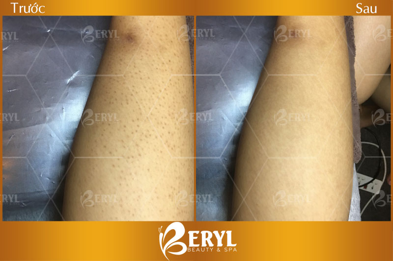 Hình ảnh trước và sau khi điều trị viêm nang lông-bằng ánh sáng sinh học tại Beryl Beauty